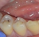Быстрое лечение зубов стоматология