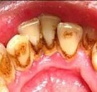 Лечение налета на зубах цена