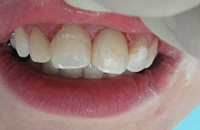 Цены на лечение и восстановление зубов