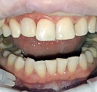 Зубы лечение без стоматологии