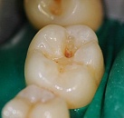 Лечение зубов у детей недорогой и хороший thumbnail