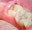 Стоматология лечение и удаление зуба мудрости