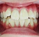 Установка брекетов и лечение зубов thumbnail