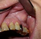 Лечение кист зубов москва