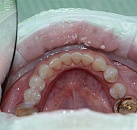 Чистка зубов с лечением цена