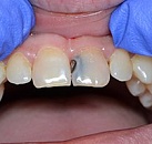 Лечение зуба в рос