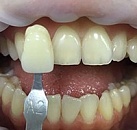 Лечение и отбеливание зубов цены