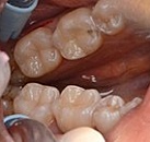 Лечение зубов под микроскопом все свои
