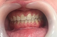 Установка брекетов и лечение зубов