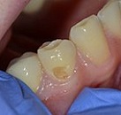 Пломба для зубов без лечения