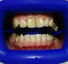 Лечение и отбеливание зубов цены