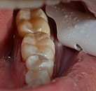 Какое есть лечение зубов thumbnail