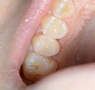 Стоимость лечения зубов фото thumbnail