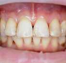 Лечение зубов по выгодным