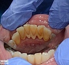 Ультразвуковое лечение зубов цена