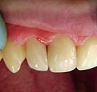 Лечение зубов современными материалами