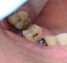 Лечение зубов современными материалами