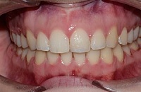 Прикус зубов неправильный лечение прайс