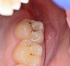 Лечение зубов в растущей