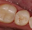 Лечение зуба на замете