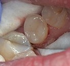 Лечение зубов под микроскопом все свои thumbnail
