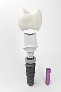 Osteofit.jpg Osteofit.jpg