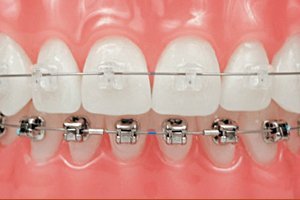 Исправление кривых зубов брекетами