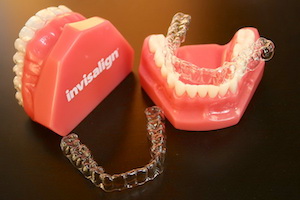 Invisalign Invisalign