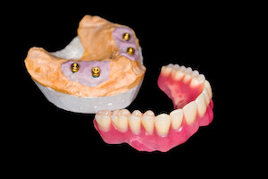 Покрывные (балочные) зубные протезы