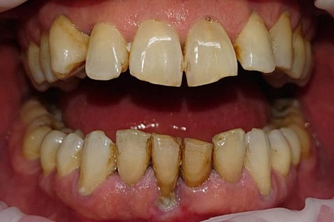 Пародонтоз — лечение в стоматологии, в домашних условиях, симптомы, фото